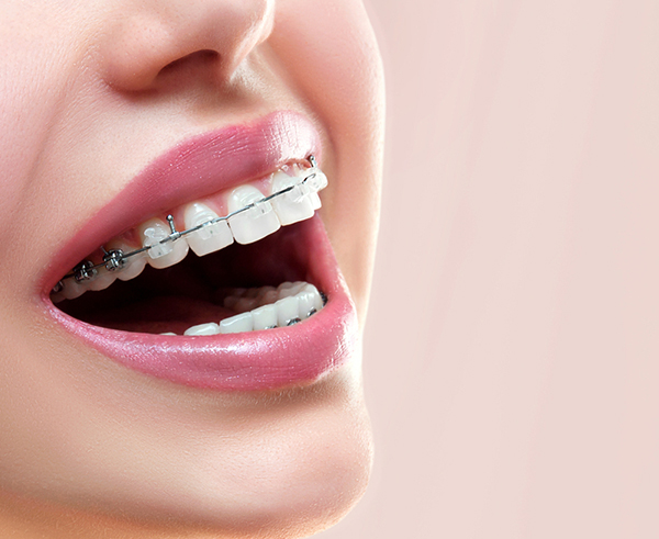Traditional Braces - Dental Solutions