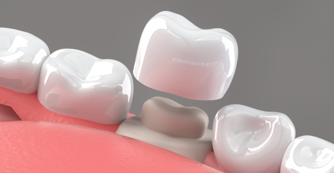 Dental Crowns Warrington - Dental Solutions