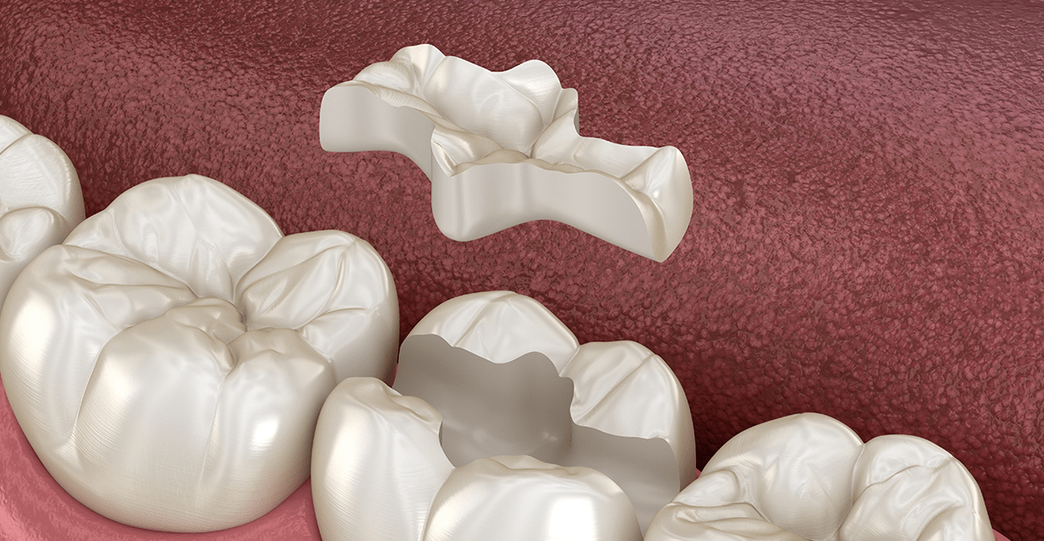 Porcelain inlays Warrington - Dental Solutions 