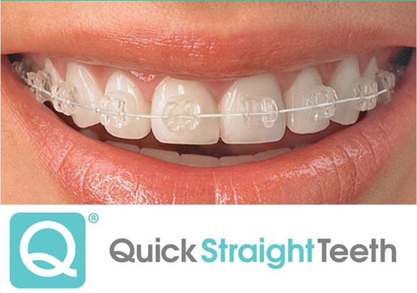 Quick Straight Teeth performed by our orthodontist Warrington - Dental Solutions