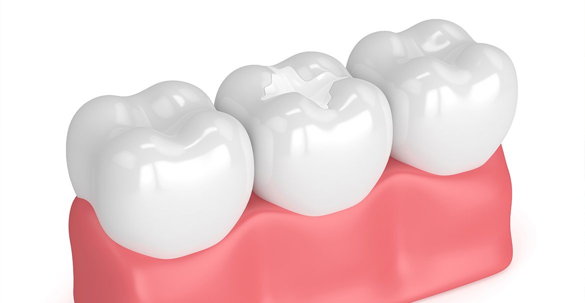 Dental fillings Warrington - Dental Solutions 