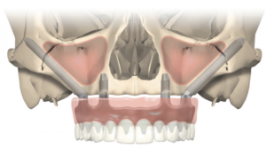 Zygomatic Implants Warrington - Dental Solutions 