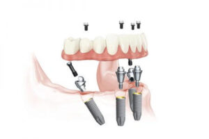 All on 4 implants Warrington - Dental Solutions 