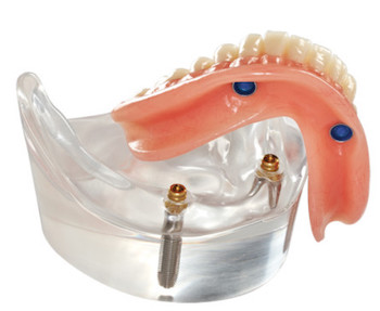Denture Implants Warrington - Dental Solutions 