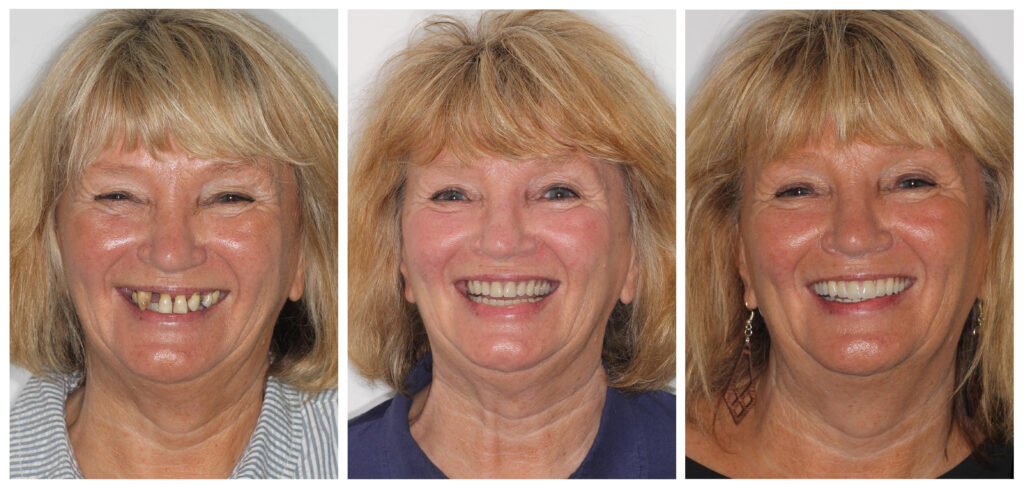 Dental Implants Warrington Before and After - Dental Solutions 
