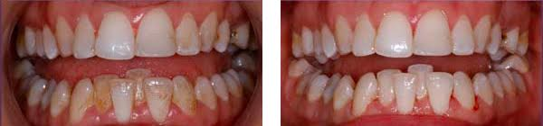 Before and after dental hygienist Warrington 